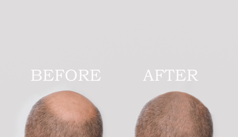 How To Regrow Hair On Bald Spot In A Matter Of Weeks